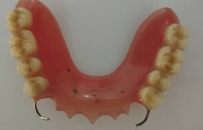 بدلة أسنان على الطاولة ويظهر سلكين معدنيين من طرفي البدلة