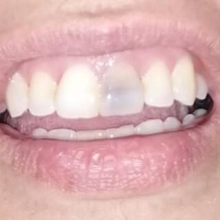 سن رمادي اللون ضمن مجموعة من الأسنان في الفم