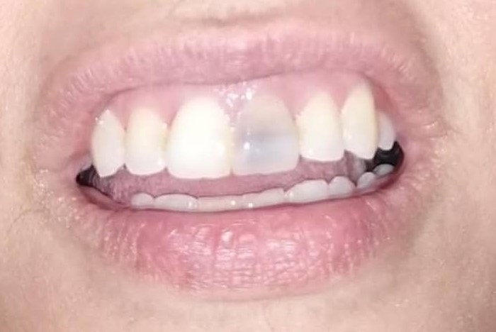 سن رمادي اللون ضمن مجموعة من الأسنان في الفم