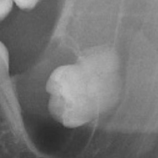 صورة شعاعية لتجويف في عظم الفك او مايدعى بالكيس السني