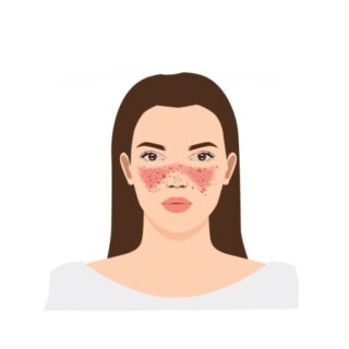 رسم توضيحي لفتاة تظهر بقع حمراء كبيرة ونقاط داكنة على وجهها