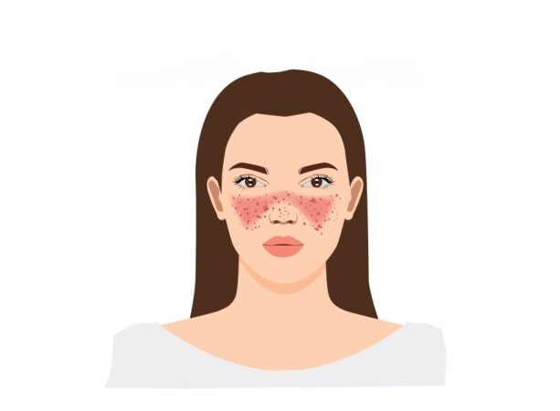 رسم توضيحي لفتاة تظهر بقع حمراء كبيرة ونقاط داكنة على وجهها