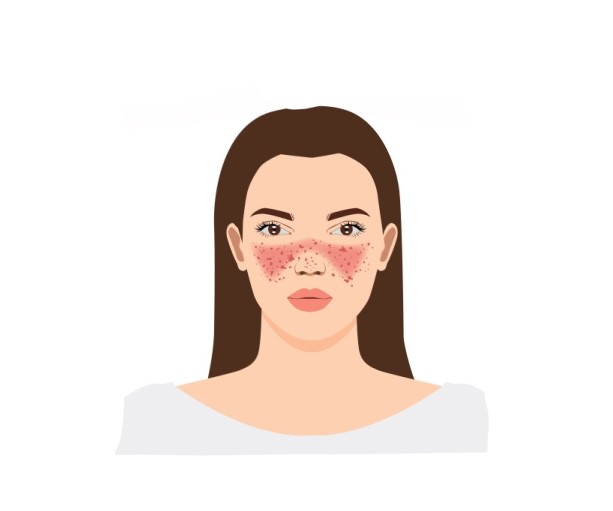رسم توضيحي لفتاة تظهر بقع حمراء كبيرة ونقاط داكنة على وجهها
