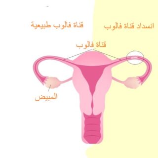 رسم توضيحي للرحم وقناة فالوب