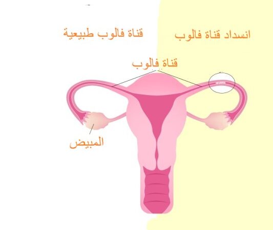 رسم توضيحي للرحم وقناة فالوب