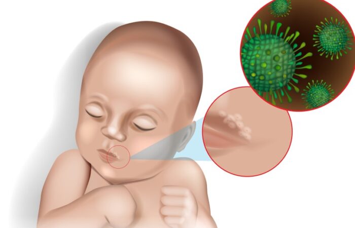 رسم ثلاثي الأبعاد لطفل رضيع مصاب بالتهاب حاد على شفته وبجانبه رسم توضيحي للفيروس الناقل للعدوى