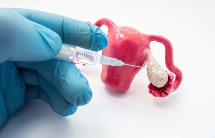 نموذج تشريحي لجهاز التكاثر الأنثوي ويد طبيب يحقن المبيض بالدواء