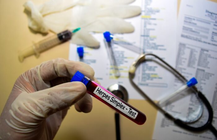 يد شخص ترتدي قفازات تمسك اختبار عينة دم مكتوب عليها بالإنكليزية Herpes Simplex - Test