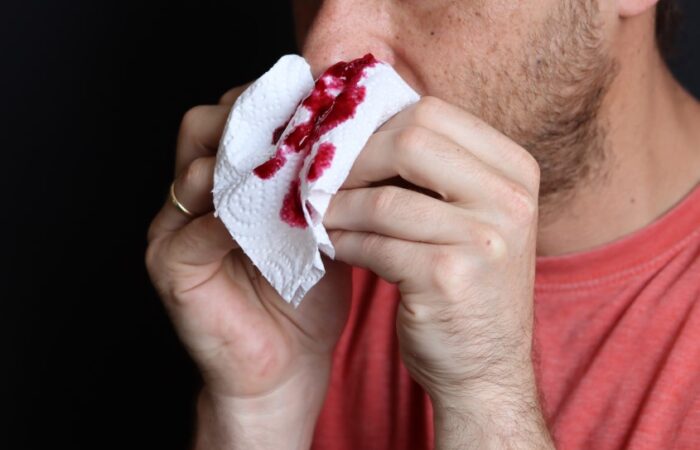 رجل يمسك منديل بين يديه ملوث بالدم موجود على أنفه