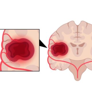 رسم توضيحي للدماغ ووجود ورم ضمنه