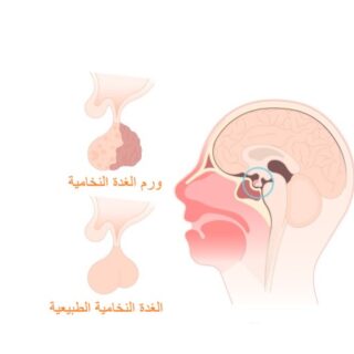 رسم توضيحي لورم الغدة النخامية