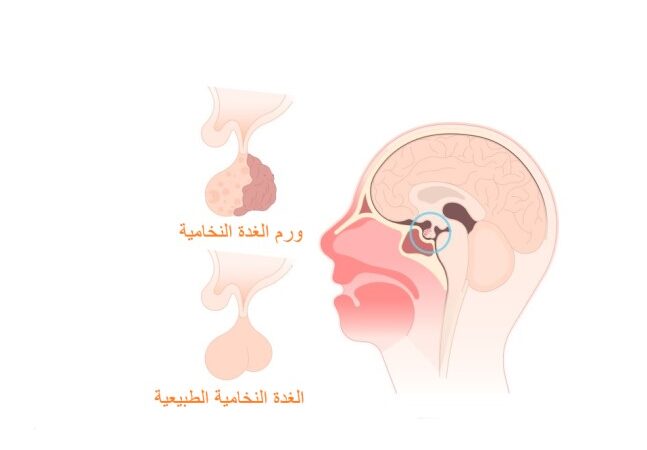 رسم توضيحي لورم الغدة النخامية