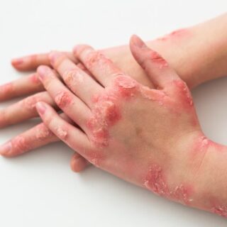 يدّ شخص مصاب بمرض جلدي على شكل تقرحات وقشور حمراء على الجلد