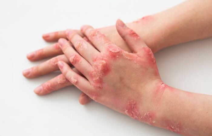يدّ شخص مصاب بمرض جلدي على شكل تقرحات وقشور حمراء على الجلد