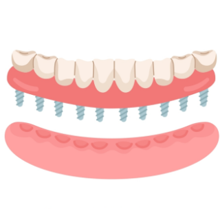 رسم تخطيطي للأجهزة الفوقية السنية