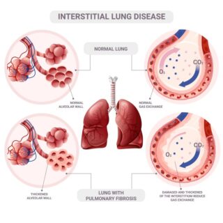 رسم توضيحي للرئة ولأمراضها
