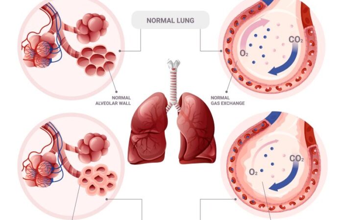 رسم توضيحي للرئة ولأمراضها