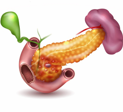 رسم توضيحي لالتهاب البنكرياس