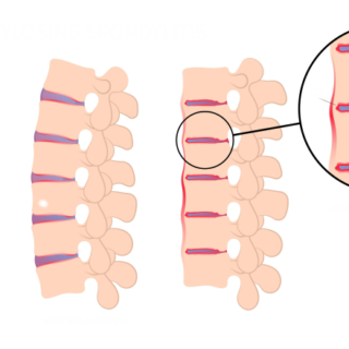 رسم توضيحي للفقرات في العمود الفقري بحالتها الطبيعية وبحالة اصابتها بالالتهاب