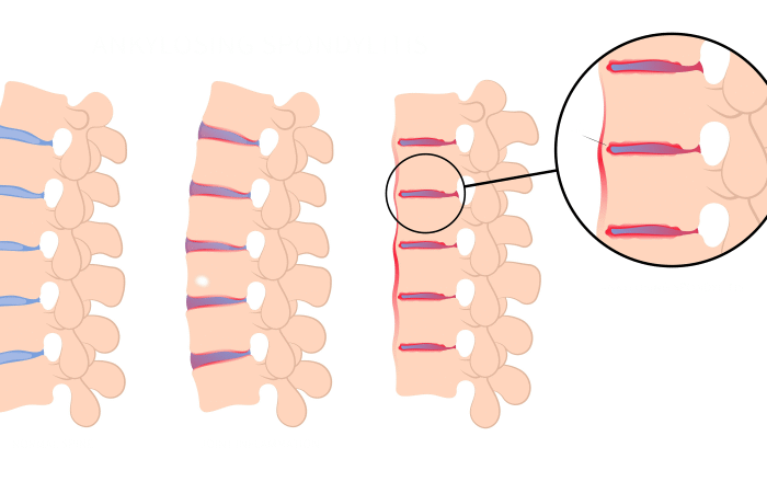 رسم توضيحي للفقرات في العمود الفقري بحالتها الطبيعية وبحالة اصابتها بالالتهاب