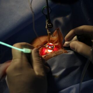 يد شخص تمسك بأدوات جراحية وتقوم بإجراء عملية داخل عين مريض