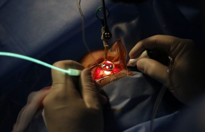 يد شخص تمسك بأدوات جراحية وتقوم بإجراء عملية داخل عين مريض