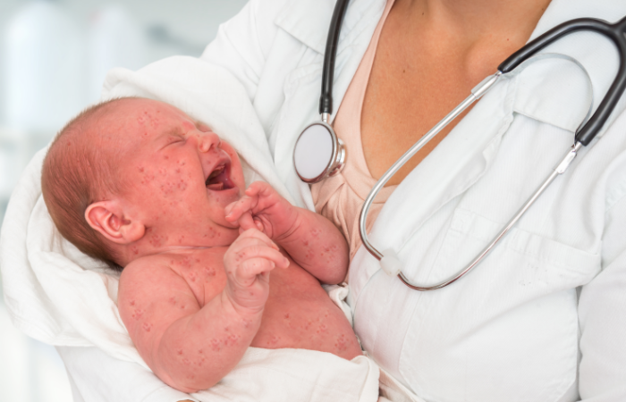 دكتورة تحمل بين ذراعيها رضيع يبكي مصاب بالحصبة الألمانية الخلقية