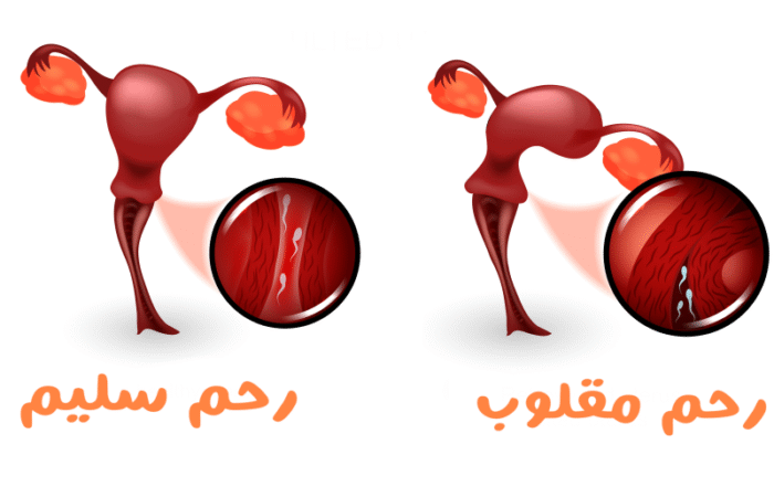 رسم توضيحي للجهاز التكاثر الأنثوي بوضعه الطبيعي وبوضعية انقلاب الرحم