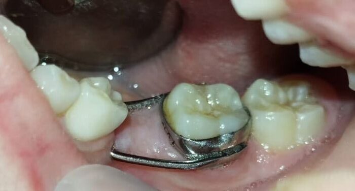أداة معدنية فضية اللون تشبه الخاتم تُحيط بسن داخل التجويف الفموي