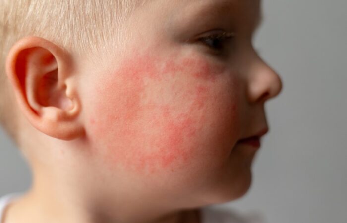 طفل أشقر اللون مصاب بطفح جلدي على خده الأيمن