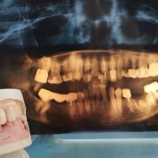 صورة شعاعية للأسنان وبجانبها مجسم للأسنان