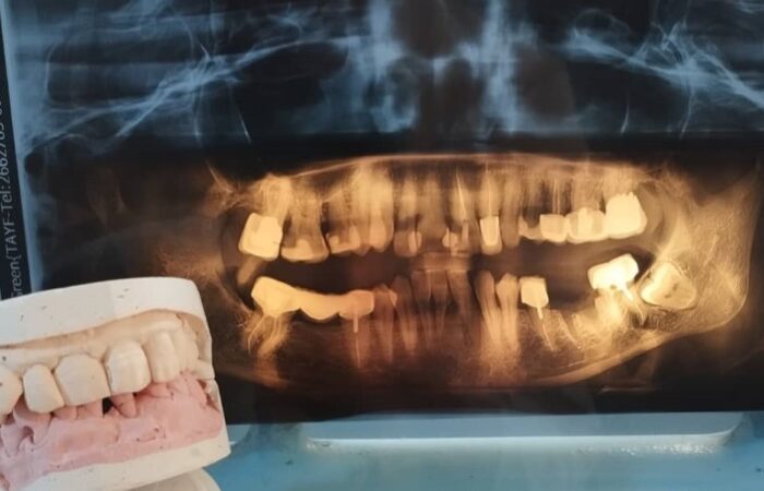 صورة شعاعية للأسنان وبجانبها مجسم للأسنان
