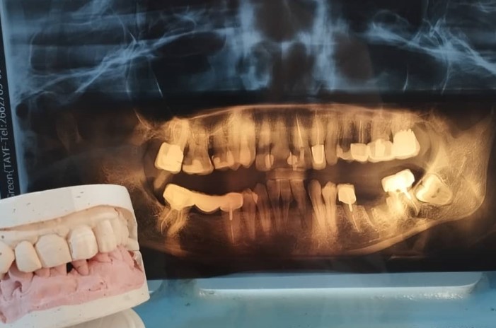 صورة شعاعية للأسنان وبجانبها مجسم للأسنان