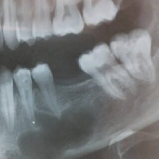 صورة شعاعية لكيس سنّي موجود تحت الأسنان
