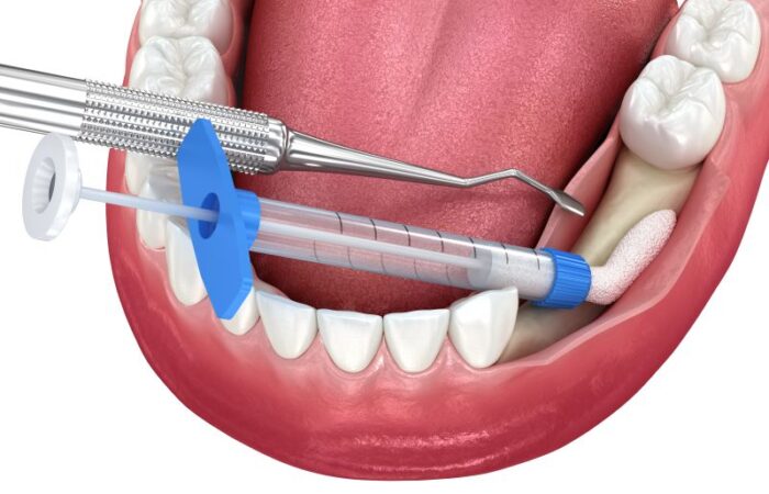 رسم توضيحي لعملية تطعيم أسنان الفك السفلي