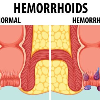 رسم توضيحي لوجود البواسير ضمن فتحة الشرج