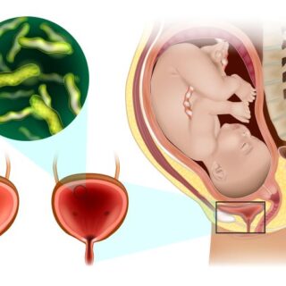 التهاب المسالك البولية أثناء الحمل