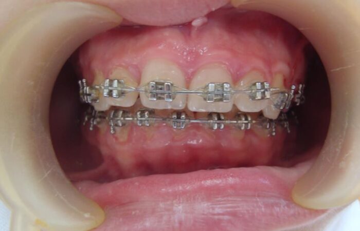 فم شخص تظهر بداخله الأسنان وعليها سلك معدني