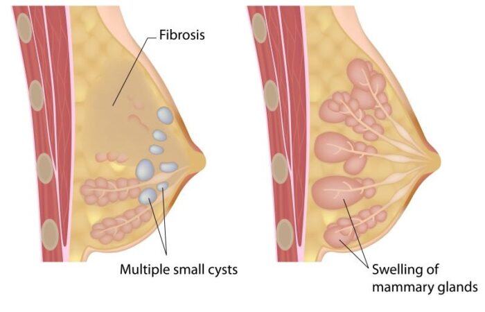 رسم توضيحي لثدي سليم وثدي يحتوي على أكياس صغيرة مملوءة بسائل أزرق اللون