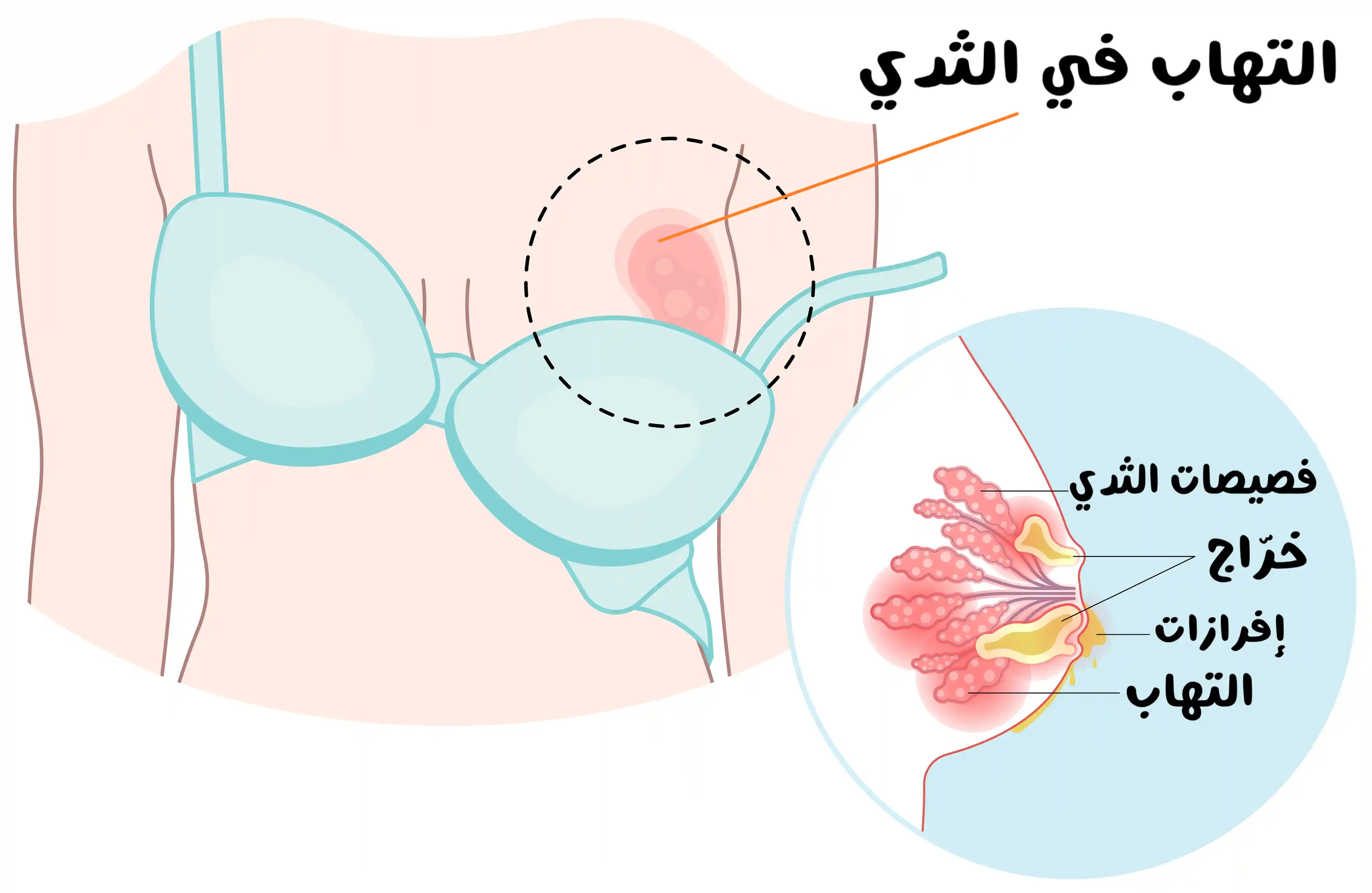 رسم توضيحي يُظهر جذع امرأة ترتدي حمالة صدر، مع إبراز منطقة حمراء داخل أحد الثديين محاطة بدائرة متقطعة وسهم يشير إليها، إضافة إلى مقطع مكبّر يُظهر فصيصات الثدي مع قنوات تخرج منها إفرازات صفراء ومناطق احمرار.