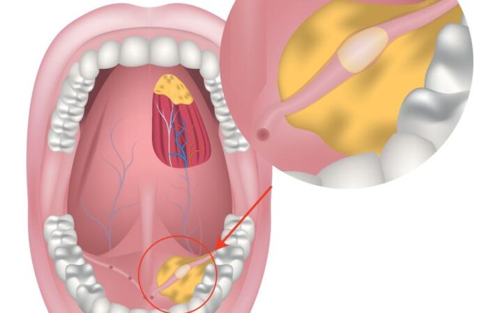 فم مفتوح تظهر فيه الأسنان وتشكل حصى داخل الغدة اللعابية