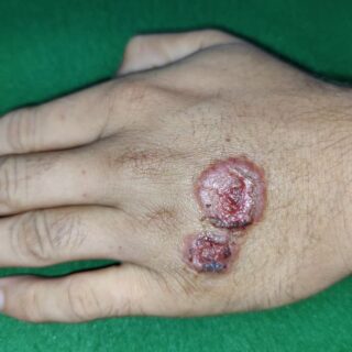 تقرحات جلدية حمراء وكبيرة على يد رَجلّ