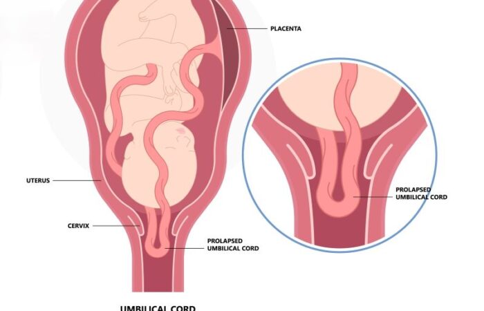 رسم توضيحي لجنين داخل الرحم وتدلي الحبل السري داخل عنق الرحم