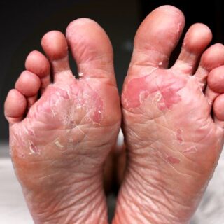 أقدام رجل بالغ مصابة بالتشقق والاحمرار