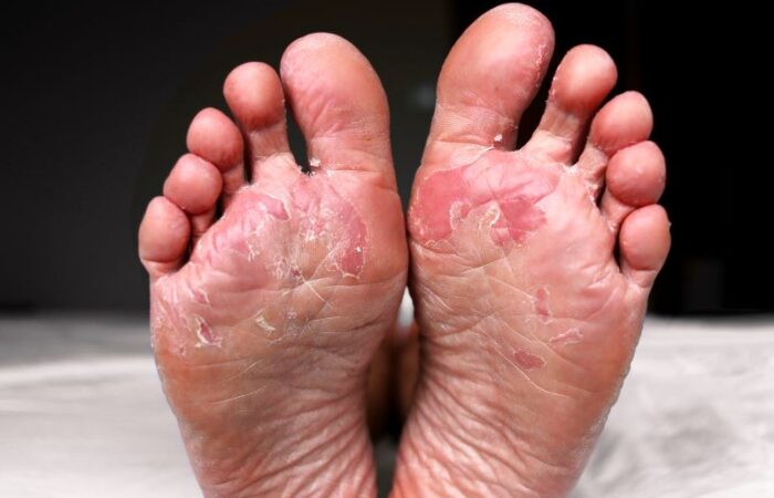 أقدام رجل بالغ مصابة بالتشقق والاحمرار