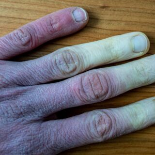 كف يد إنسان بالغ ويظهر أطراف الأصابع بلون أبيض