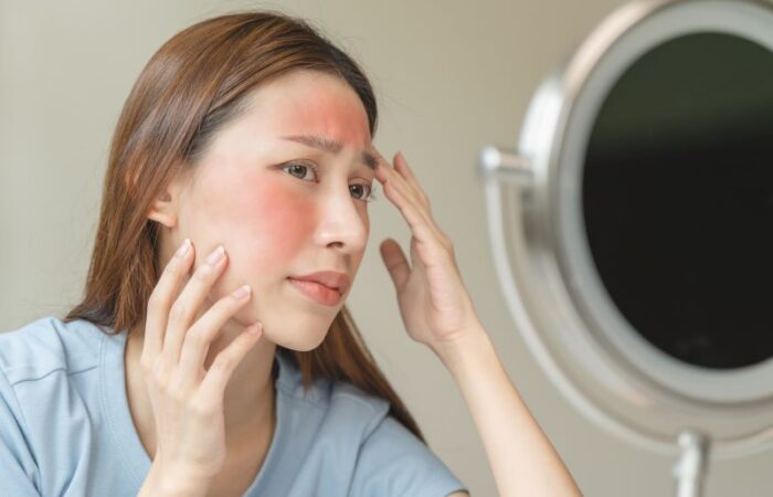 فتاة مراهقة قلقة تنظر للمرآة حيث يظهر على خدها وجبينها احمرار