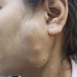 امرأة بالغة يظهر أسفل خدها الأيسر كتل كبيرة متجمعة تحت الجلد