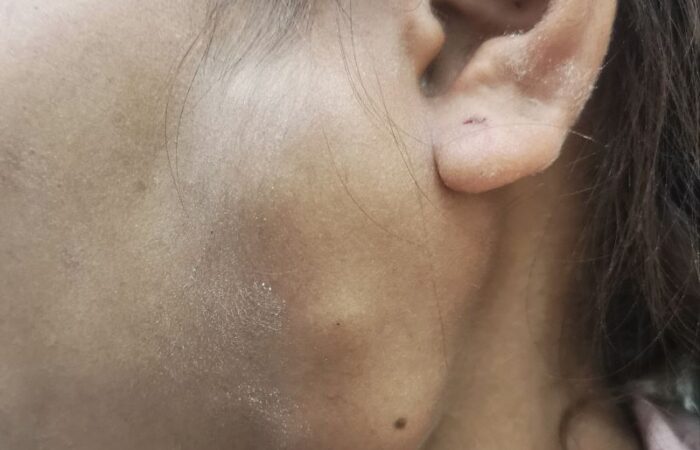 امرأة بالغة يظهر أسفل خدها الأيسر كتل كبيرة متجمعة تحت الجلد