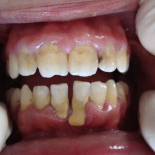 أسنان شخص بالغ حيث يظهر جذر أحد أسنان الفك السفلي